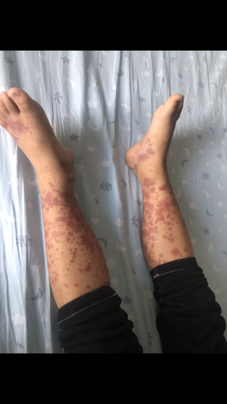 过敏性紫癜_过敏性紫癜症状表现 - 好大夫在线