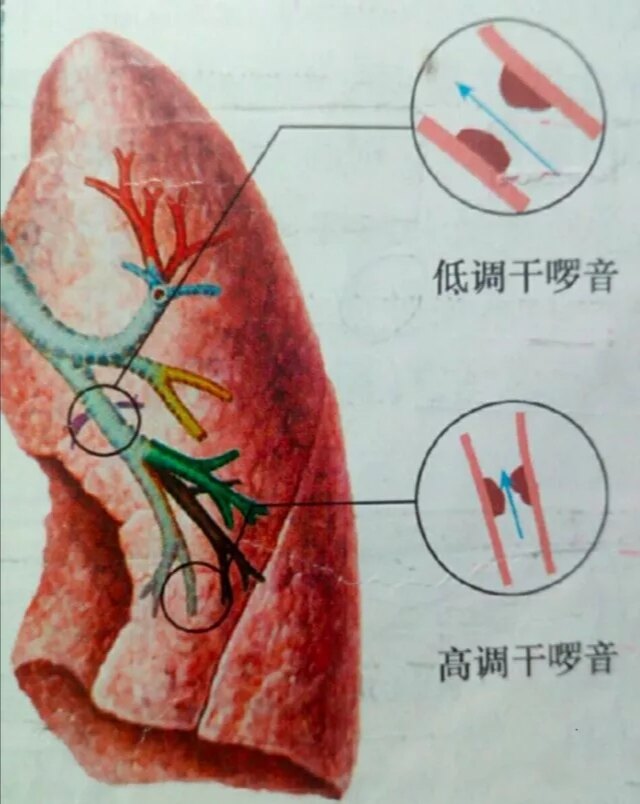 怎样辨别肺部湿啰音干啰音