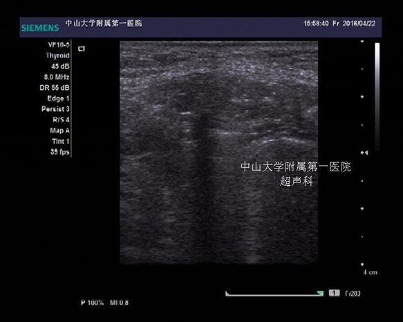 白线疝超声图片图片