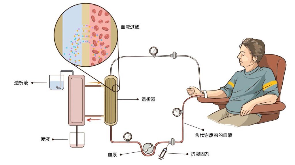 血透动静脉瘘示意图图片