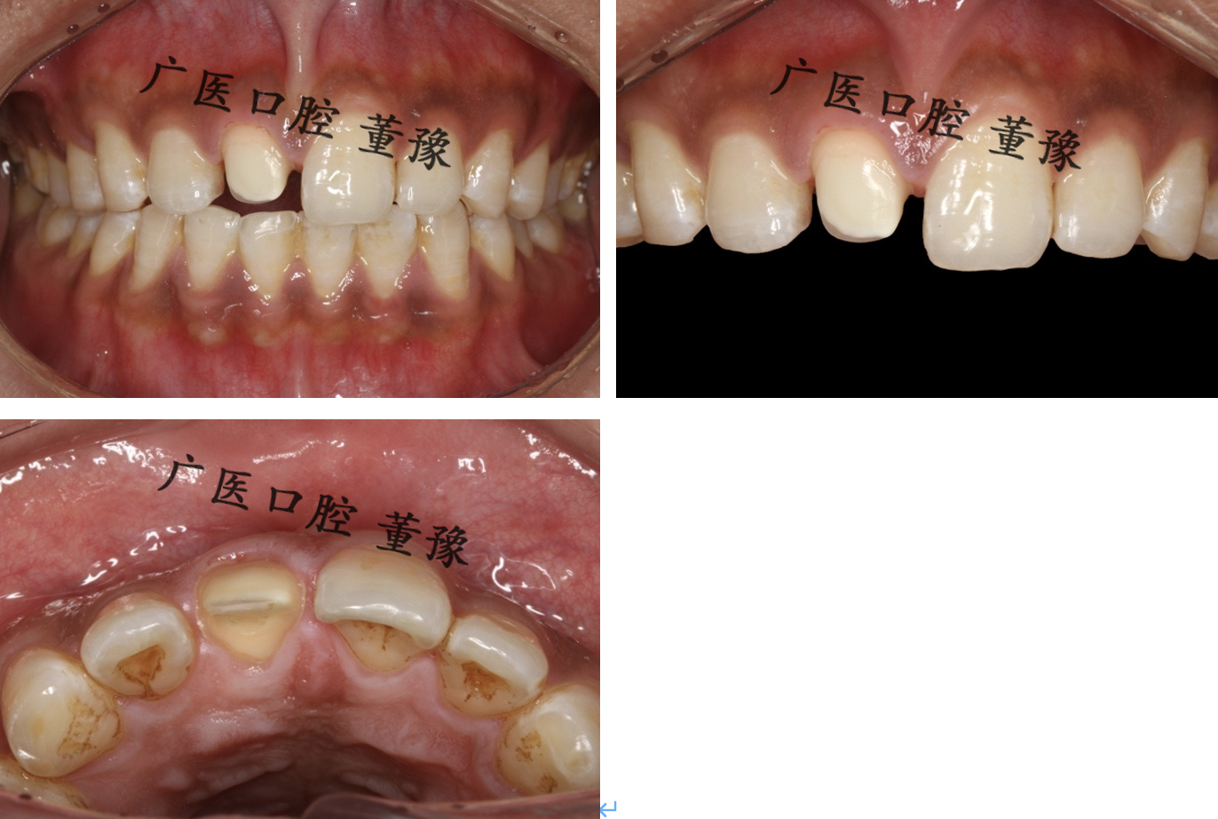 镶牙全过程图片