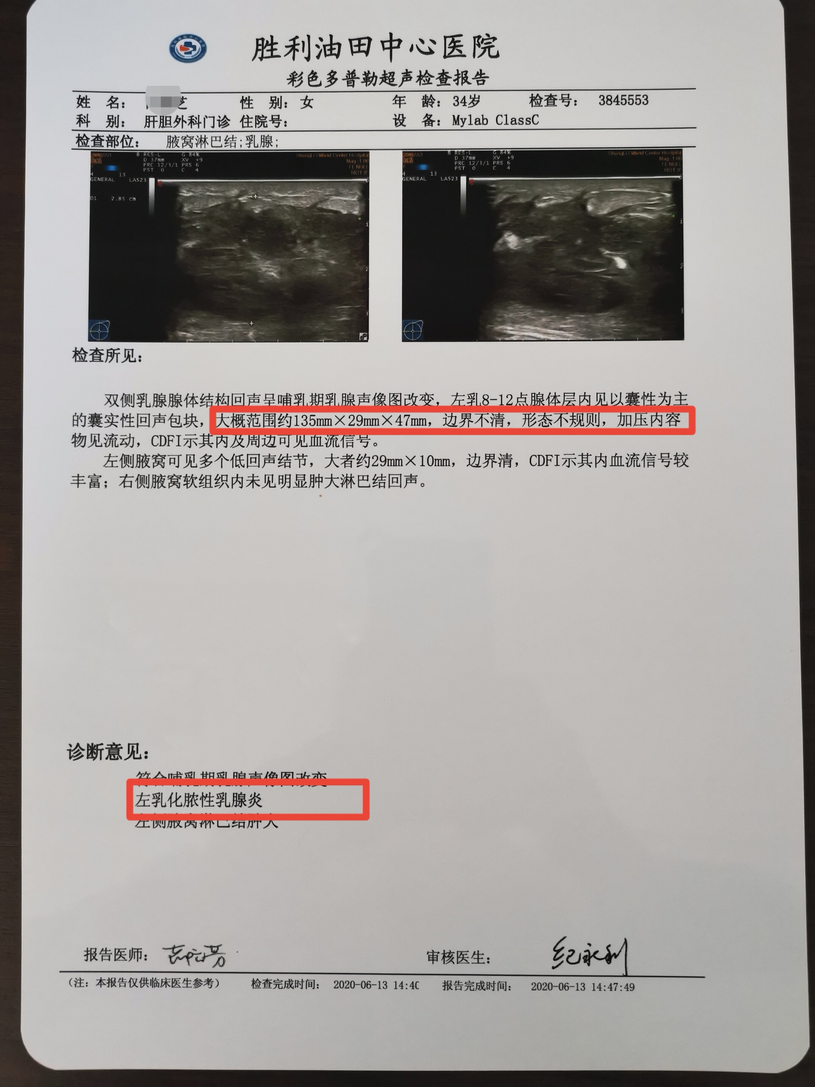 乳腺囊肿超声图片报告图片
