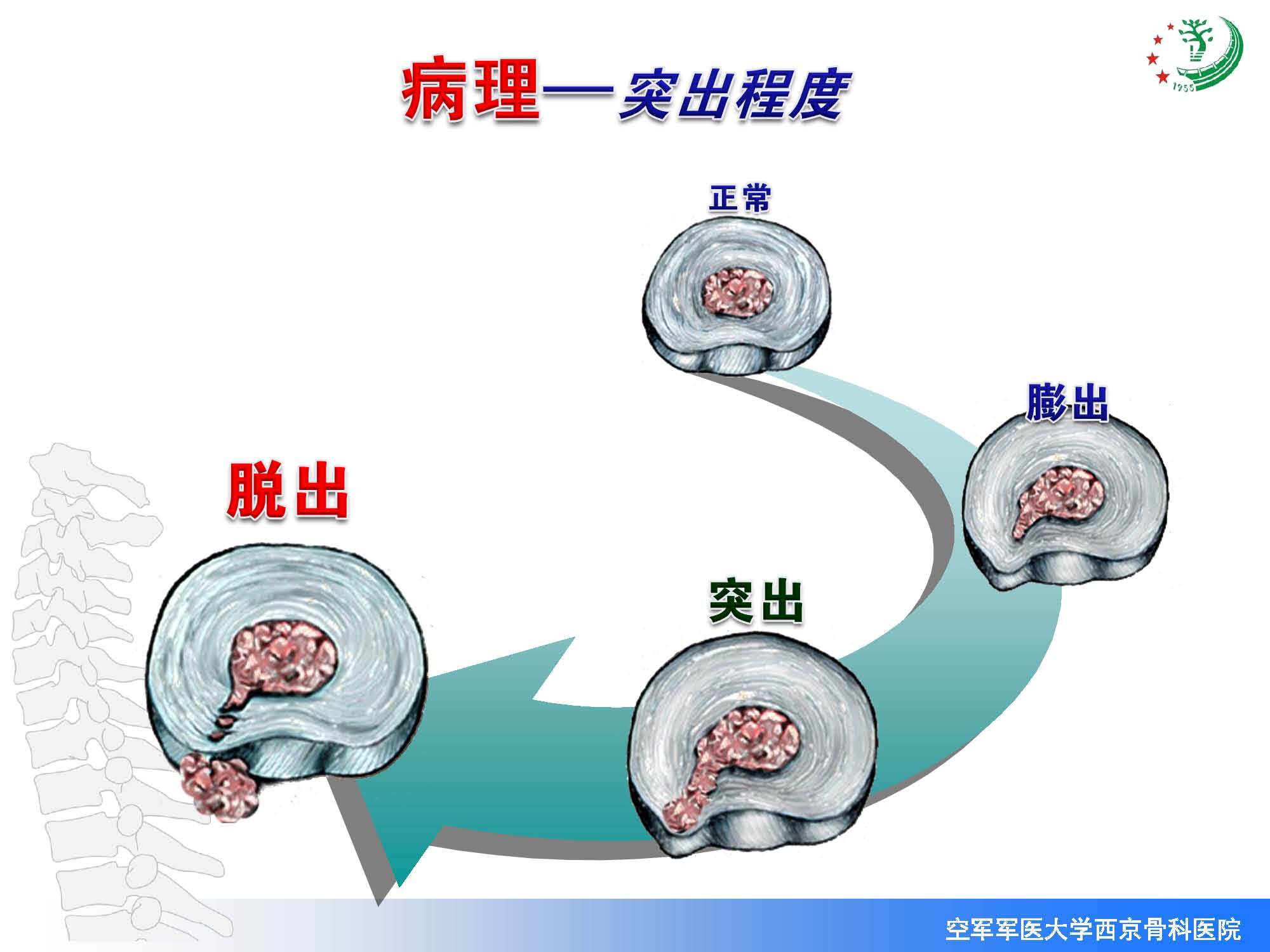 腰椎間盤突出症示意圖腰椎管狹窄症示意圖