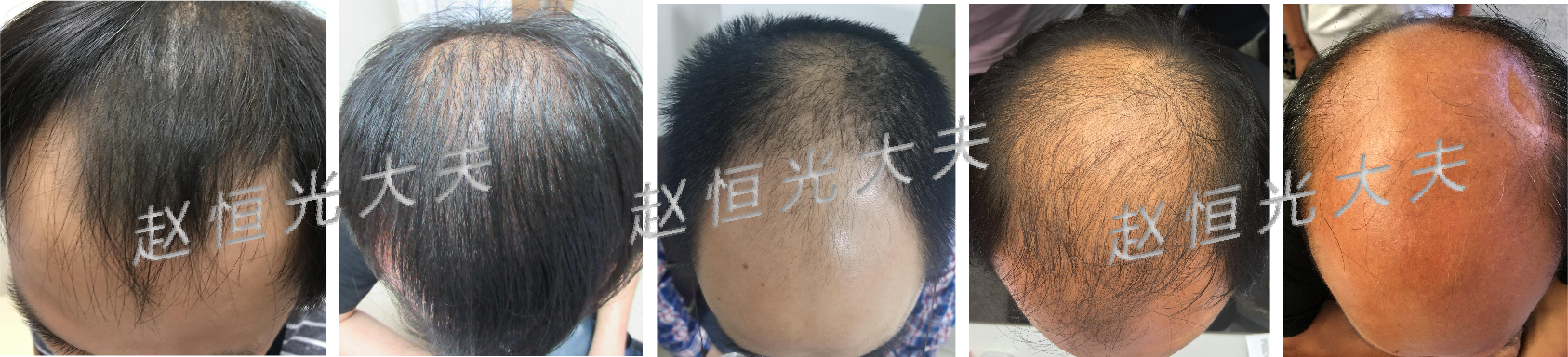 一组典型的男性雄激素性秃发的发展过程_雄激素性脱发_雄激素性脱发