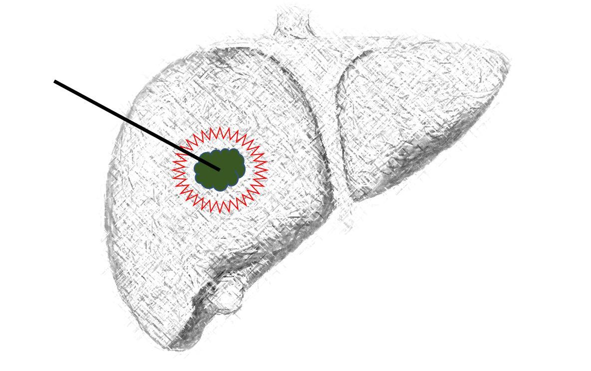 <!--HAODF:8:ganai--><!--HAODF:8:ganai--><!--HAODF:8:ganai-->肝癌<!--HAODF:/8:ganai--><!--HAODF:/8:ganai--><!--HAODF:/8:ganai-->消融.jpg