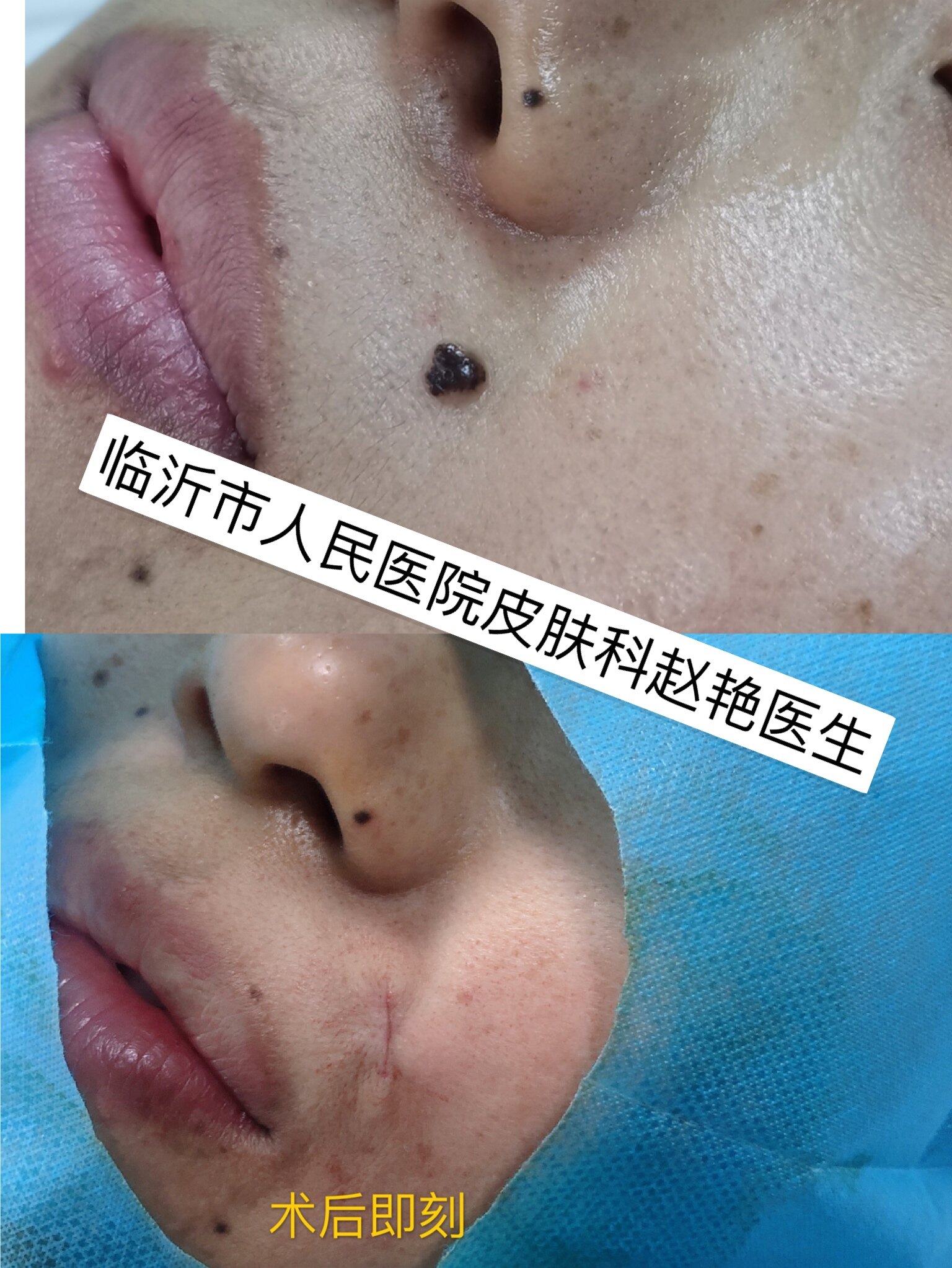 肿瘤黑色素瘤吃什么药_黑色瘤素癌初期症状_皮肤黑色素瘤能治愈吗