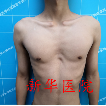 发现漏斗胸应该马上手术吗 可以择期手术吗 继续等待会影响孩子生长发育吗 漏斗胸 漏斗胸 发现漏斗胸应该马上手术吗 可以择期手术吗 继续等待会影响孩子生长发育吗 漏斗胸 漏斗胸