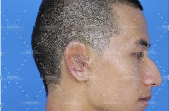 耳畸形案例——小新的耳再造手术分享