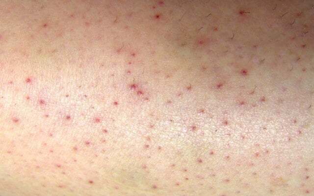 皮肤淤青是得了白血病吗?