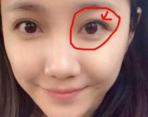 2,双眼皮弧度不佳东方人上睑窄,眼窝平,眉弓低,上睑厚,双眼皮不宜做得