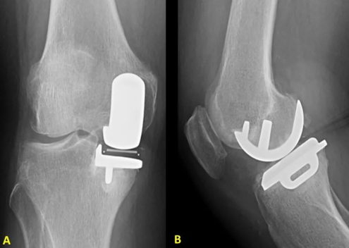 膝关节单髁置换术可用于治疗膝关节单间室骨关节炎患者,可以说这是一