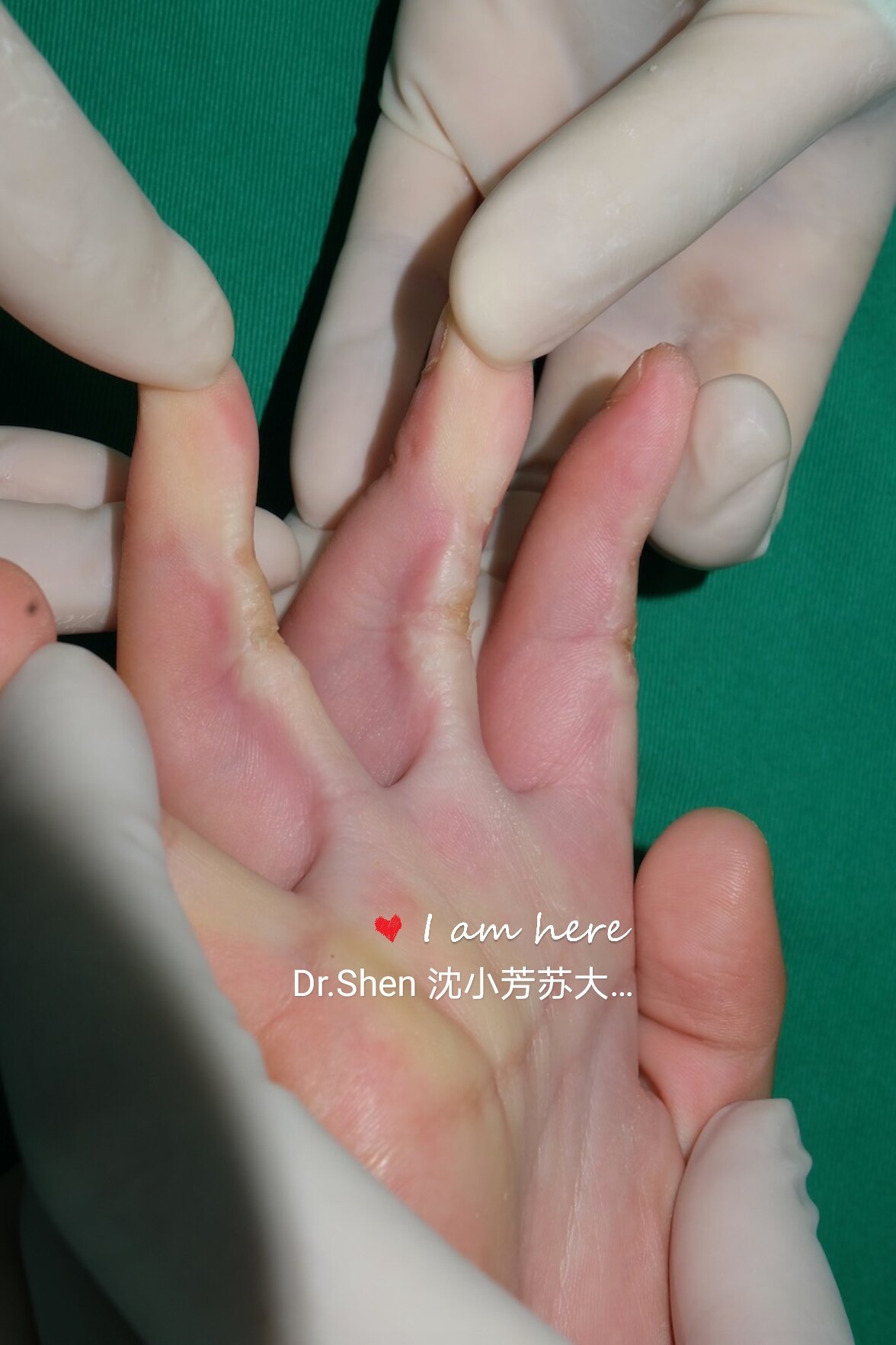 _手臂燙傷脫皮了會(huì)留疤嗎_脫毛燙傷皮膚