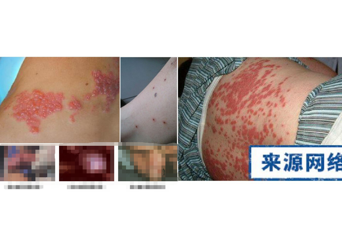 你中过招吗 花柳病 有哪些常见症状 性病 好大夫在线 你中过招吗 花柳病 有哪些常见症状 性病 好大夫在线