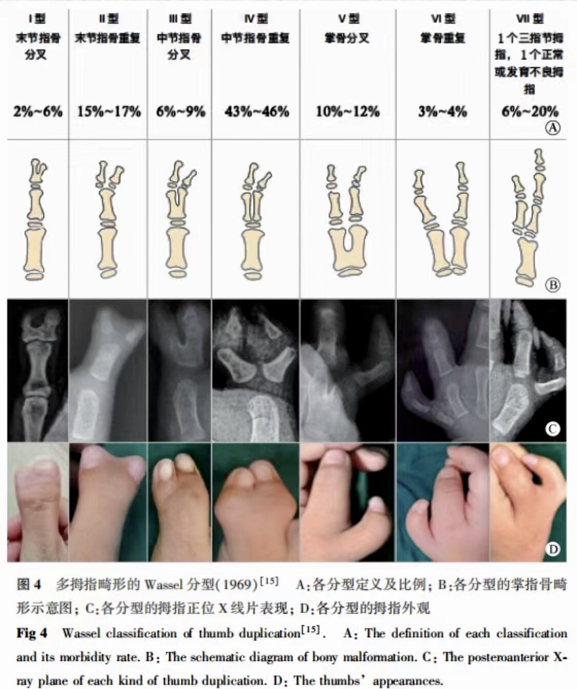 拇指多指畸形之一镜像拇—b-c手术_多指畸形_多指畸形治疗方式 - 好