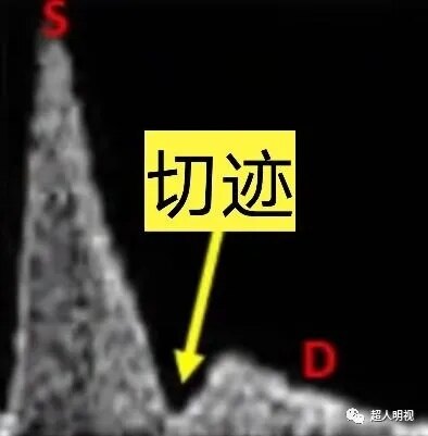 3,孕24周后子宫动脉舒张期切迹不正常!