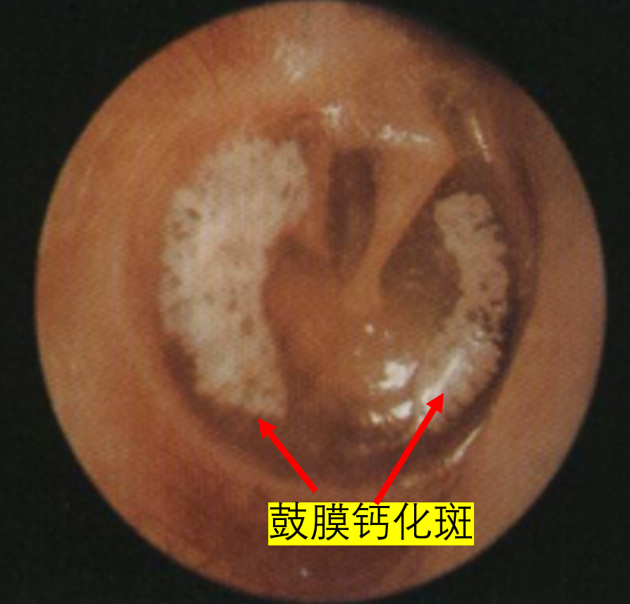 鼓膜的34颜色与疾病