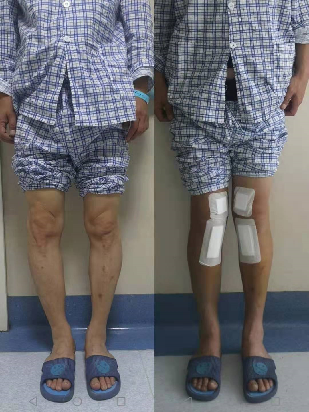 手术矫正腿型图片