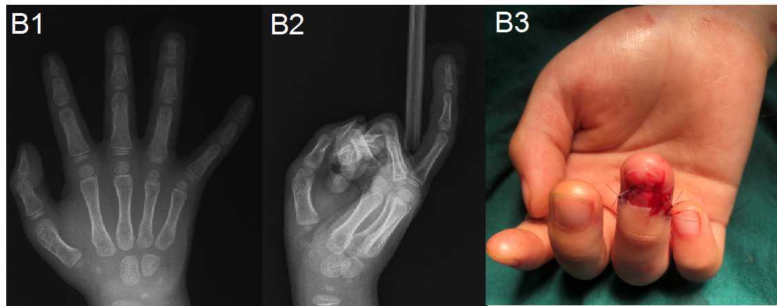 意外门夹伤致儿童环指远节开放性指骨骨折,我们值得关注!