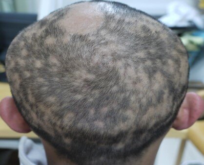 斑秃是一种常见的脱发类疾病,表现为突然出现的边界清楚的圆形脱发斑