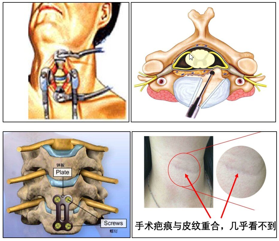 颈椎病怎么做手术?_颈椎病_发病原因_症状表现_治疗方式 - 好大夫在线