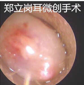 外耳道出血性肿物能做耳内镜微创手术吗