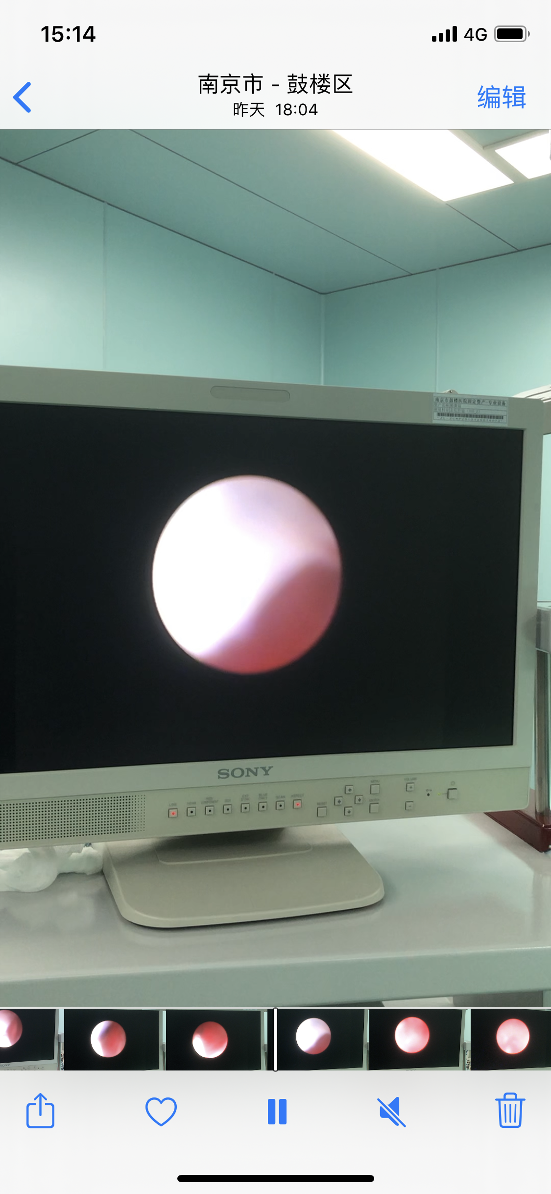 手术日志29精囊镜手术治疗血精无精精索静脉曲张显微手术