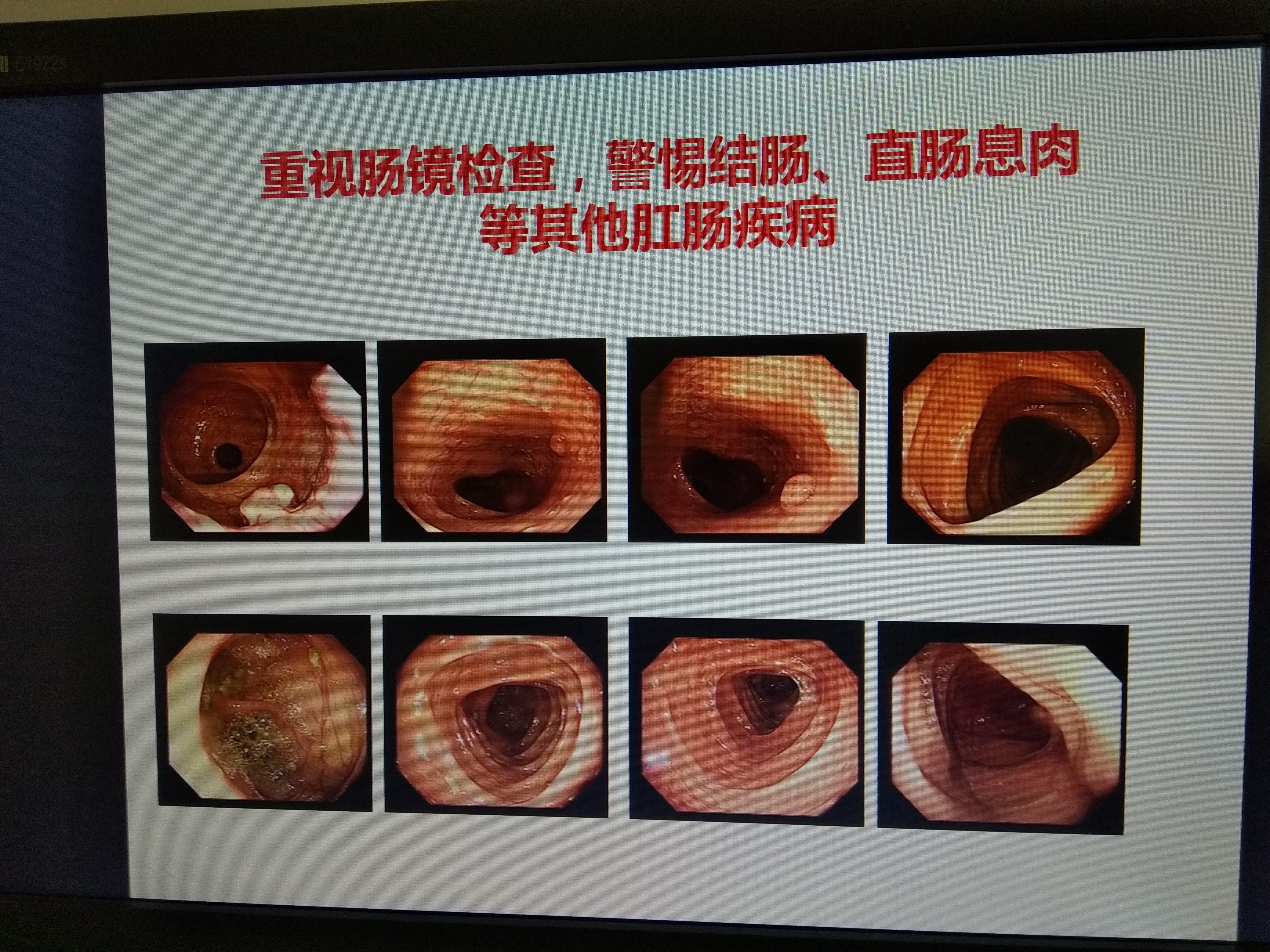 便血應重視腸鏡檢查尤其有明顯混合痔存在時也不應忽視腸鏡檢查因為有