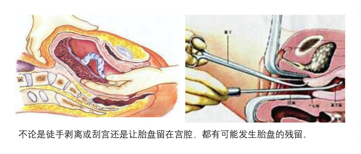 产后胎盘出不干净怎么办?怎么会这样呢?