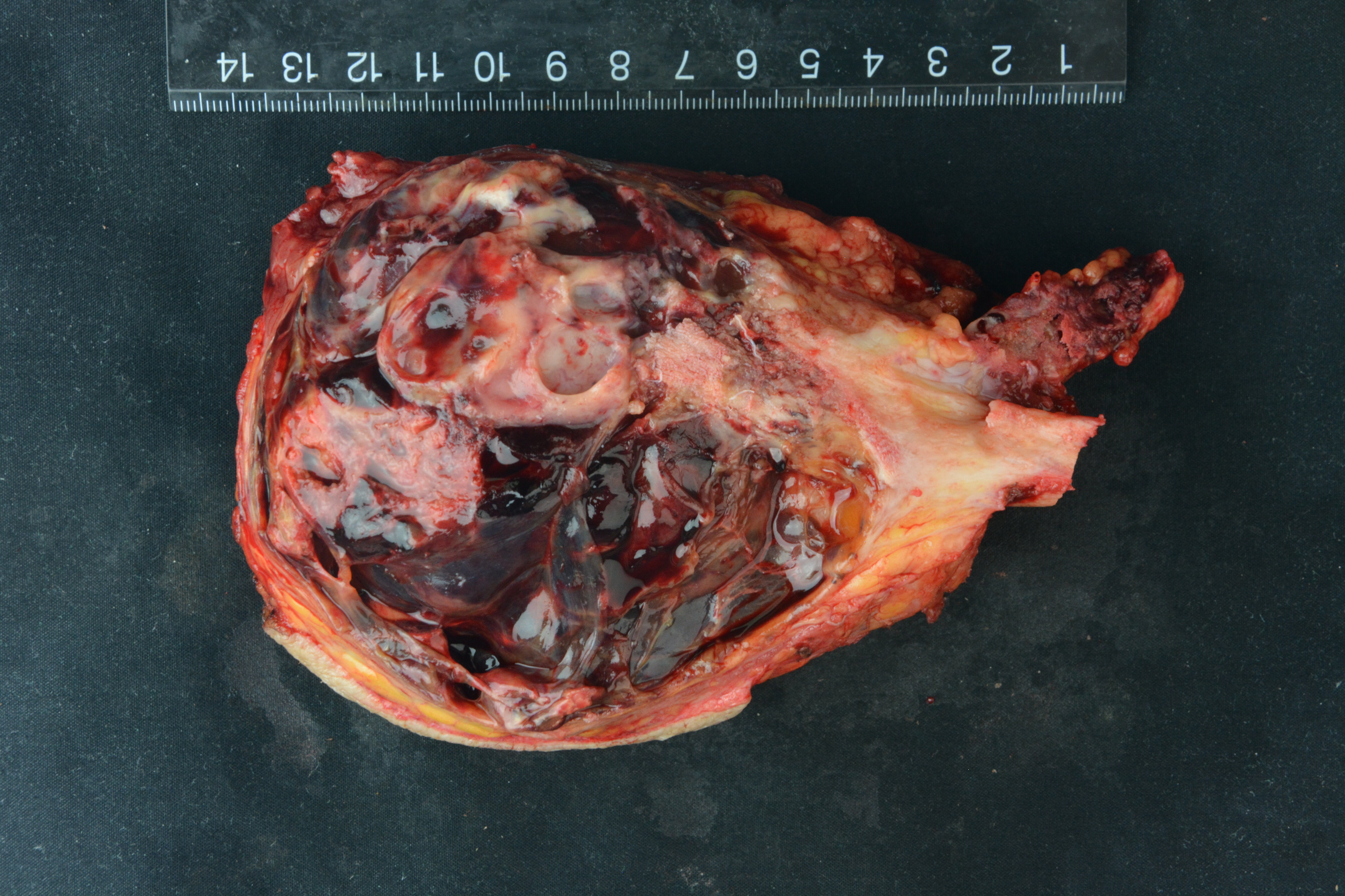 癌细胞扩散后解剖图片图片