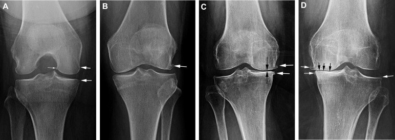 膝关节骨关节炎——阶梯性治疗策略