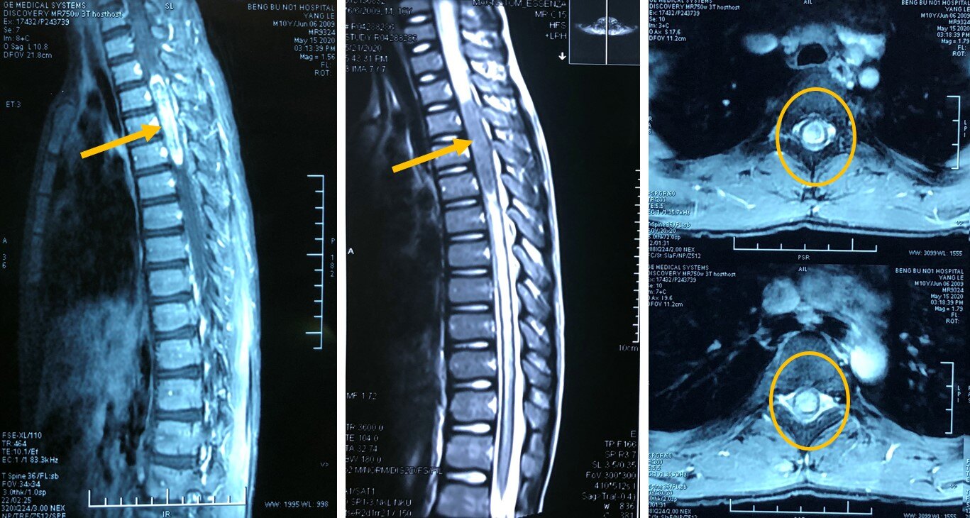 椎管内肿瘤影像ppt图片