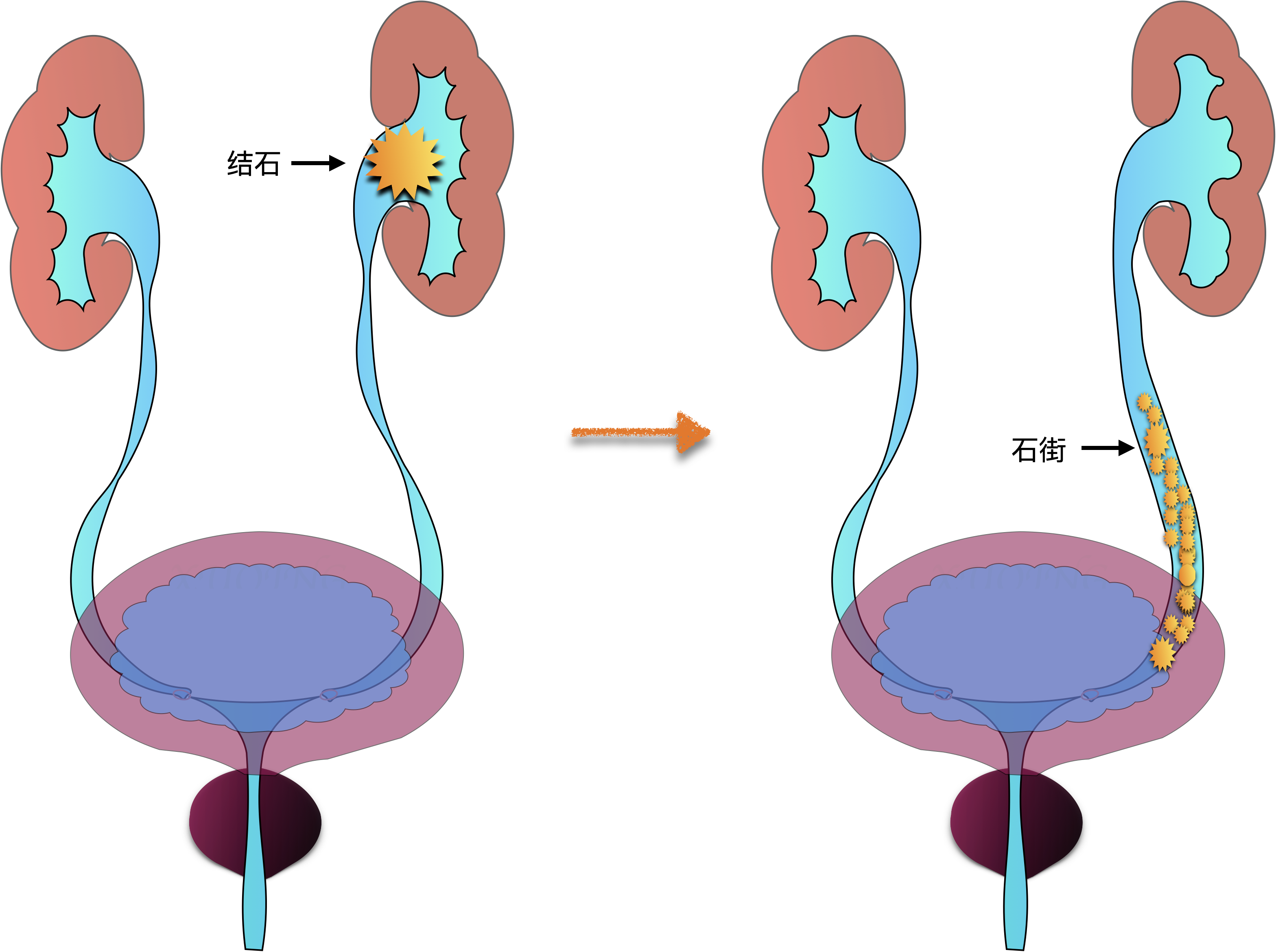 尿路结石形成石街是怎么回事,怎么办?_泌尿系结石 好大夫在线