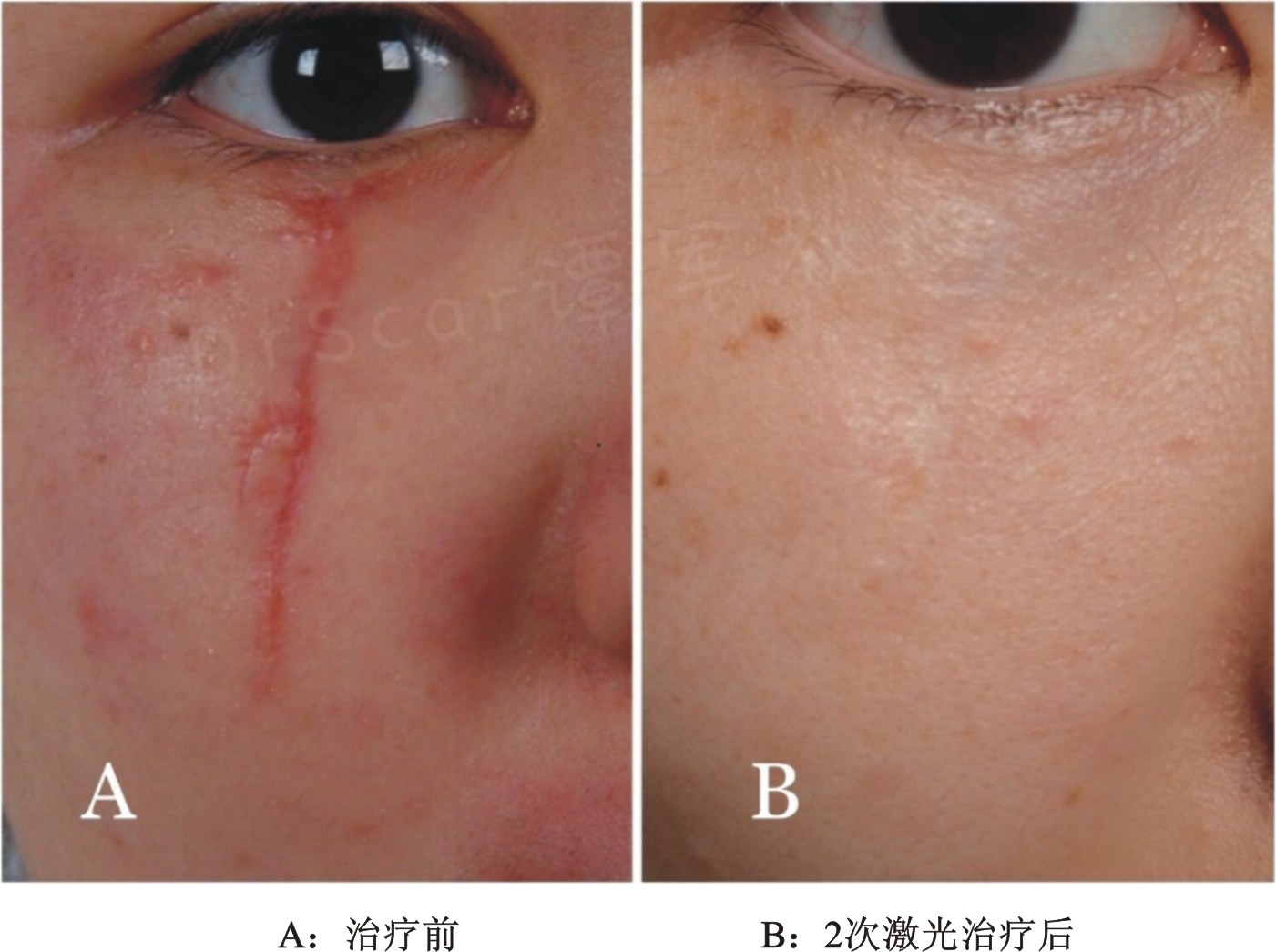 黑痣会癌变吗_脚底黑痣癌变_黑痣癌变图片