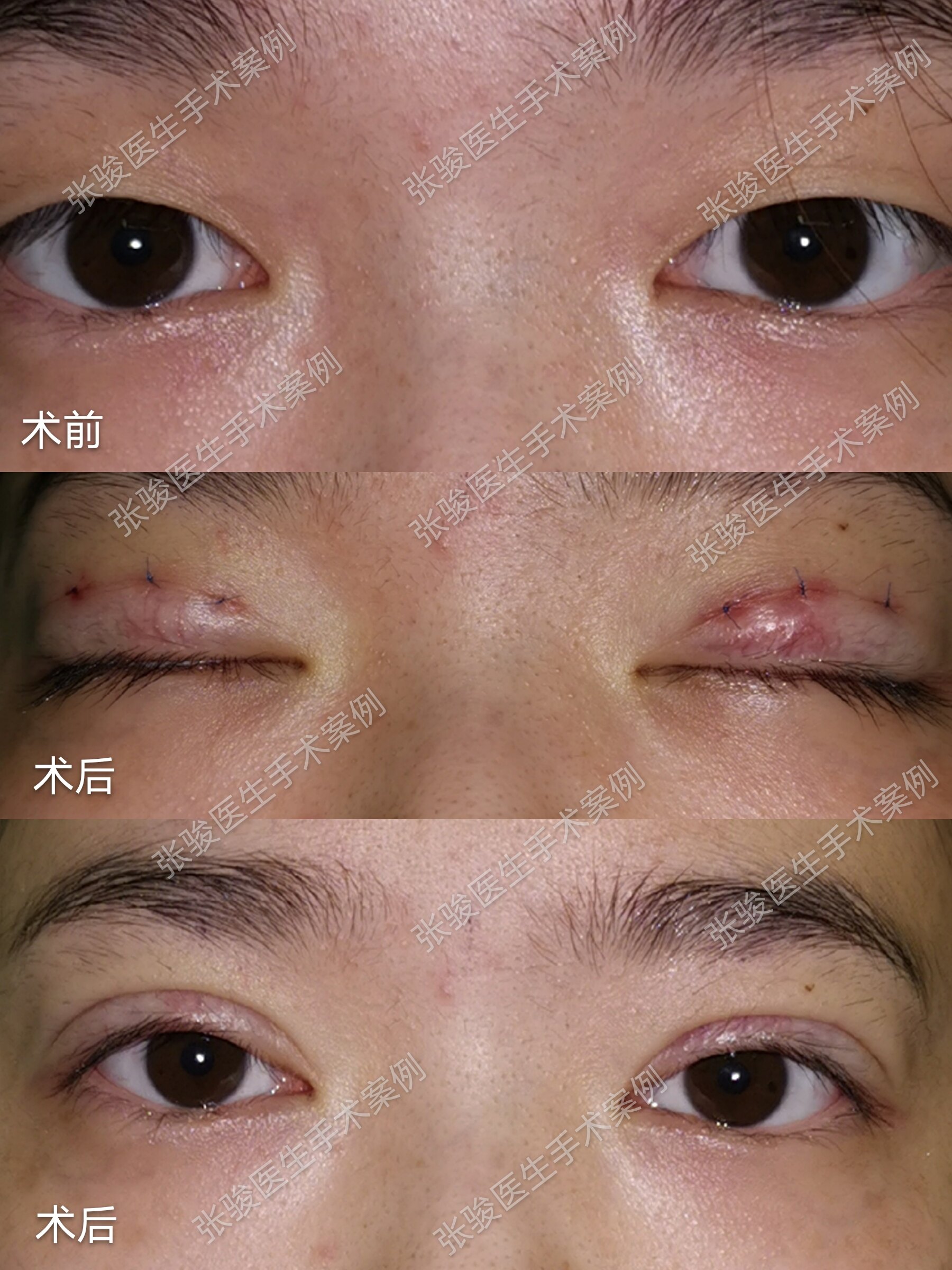 三点微创双眼皮手术案例_双眼皮手术_双眼皮手术治疗介绍 - 好大夫