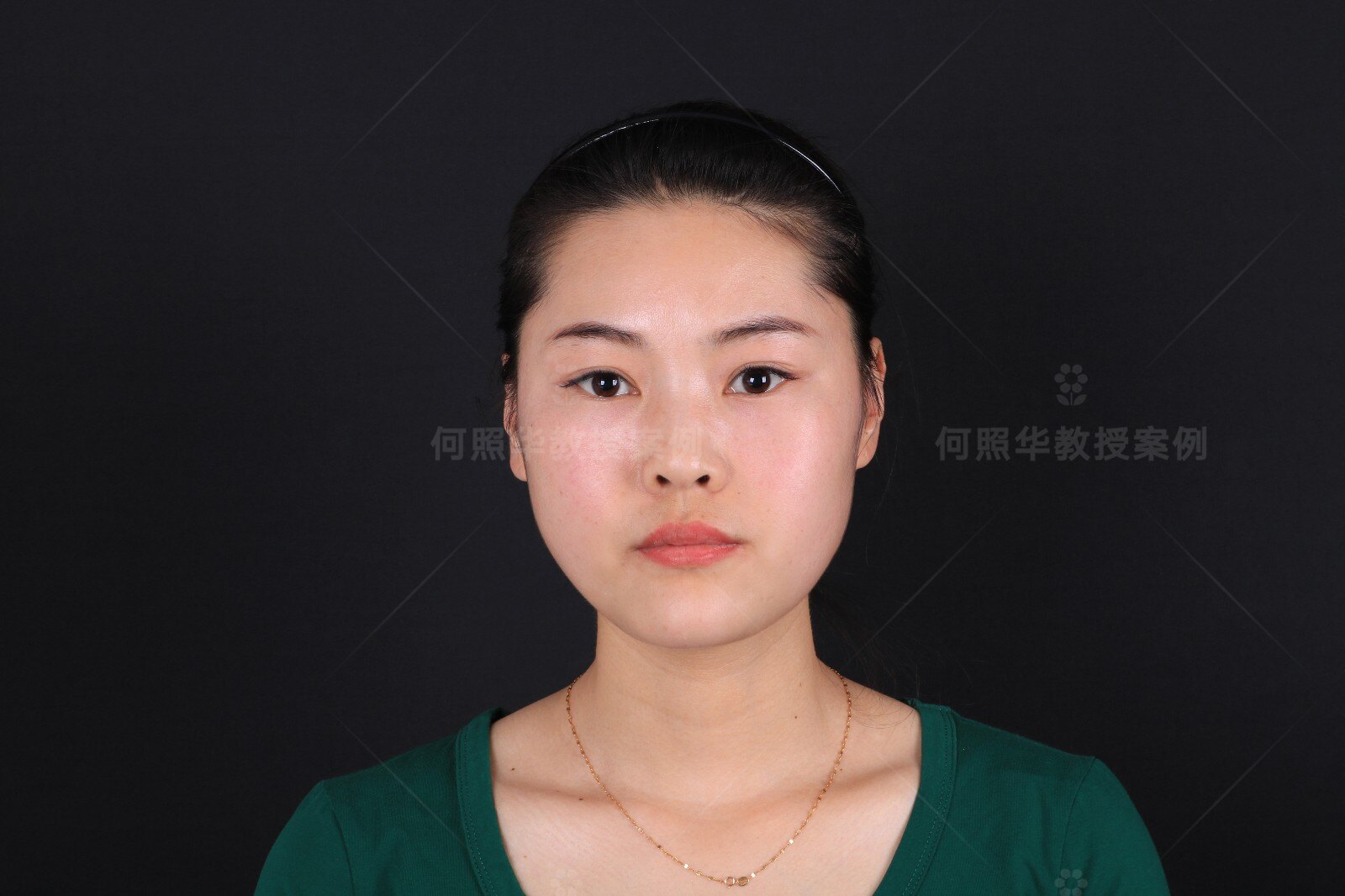 方脸小姐姐必看!如何快速拥有上镜小脸?_面部轮廓整形 - 好大夫在线