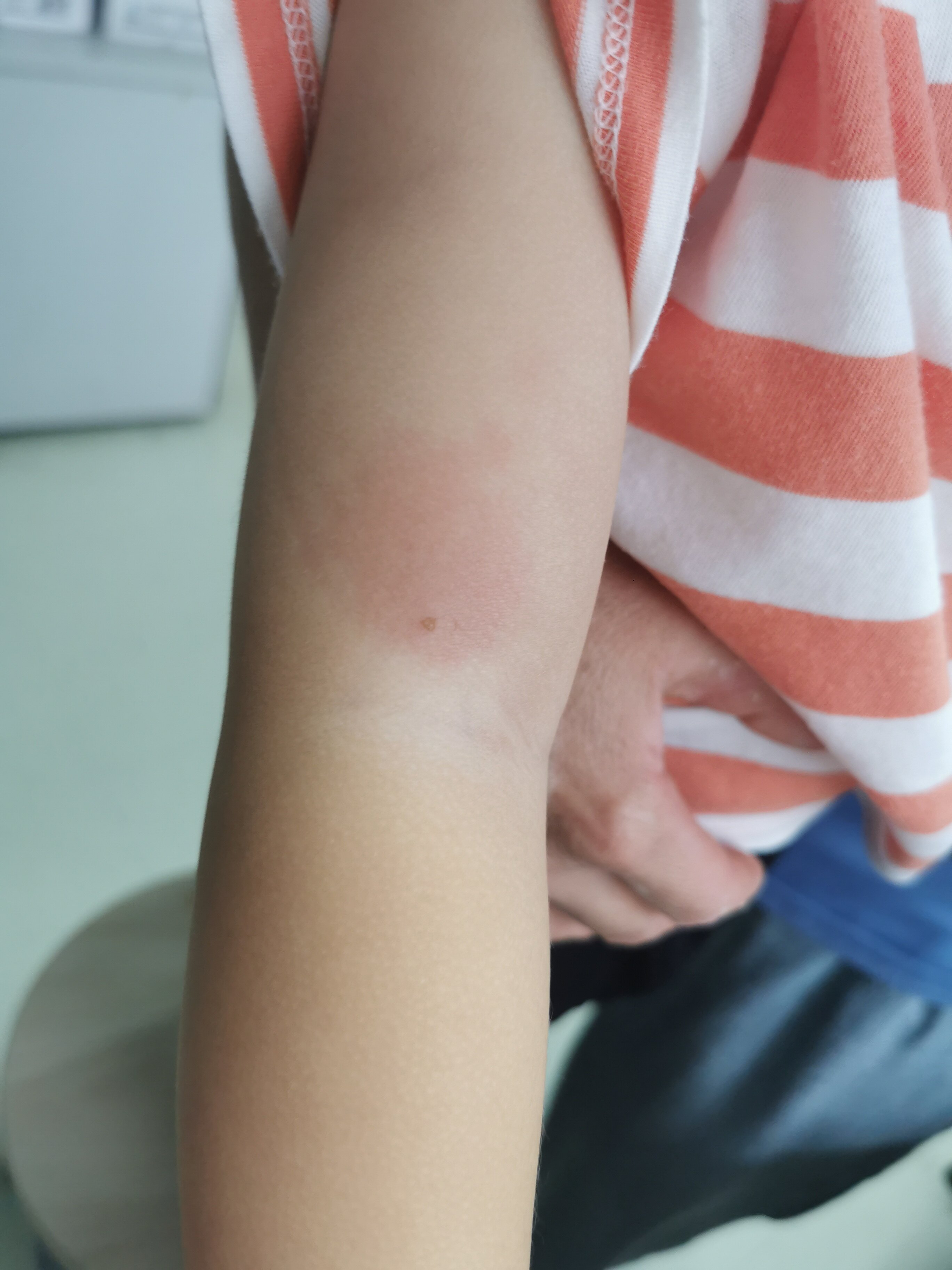 夏季:虫咬皮炎不可小视!