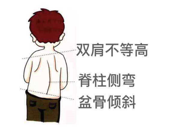 青少年特发性脊柱侧凸的家长手册及网上就医前注意事项_脊柱侧弯_介绍