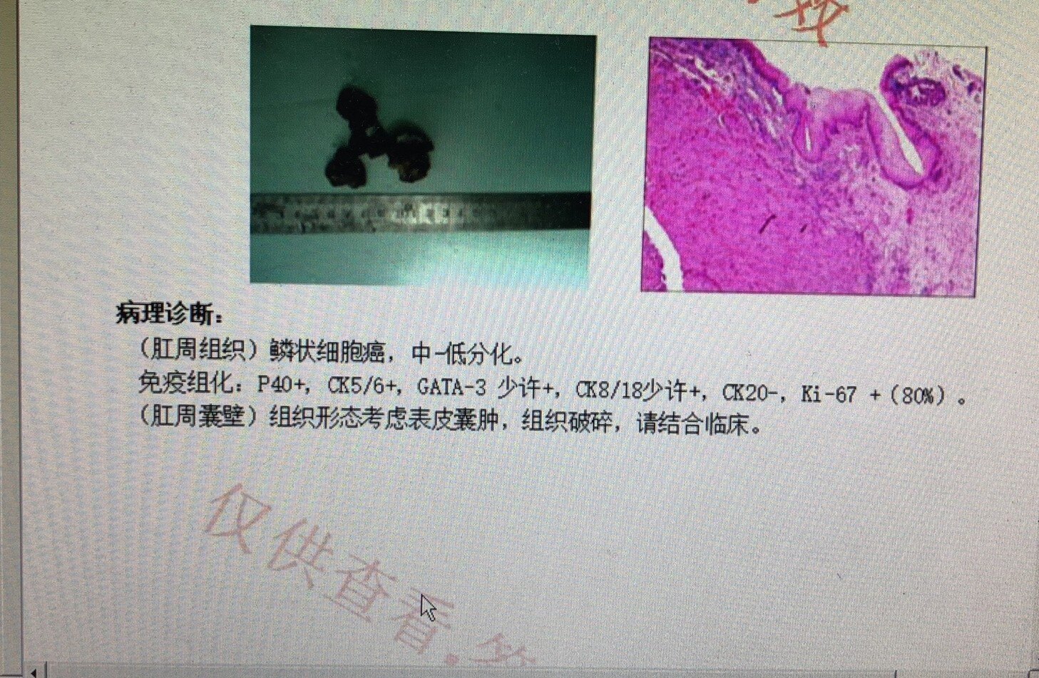 痔疮会癌变吗混合痔癌变病例一例分享