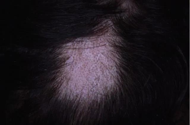 斑秃_斑秃_症状表现_预后 - 好大夫在线