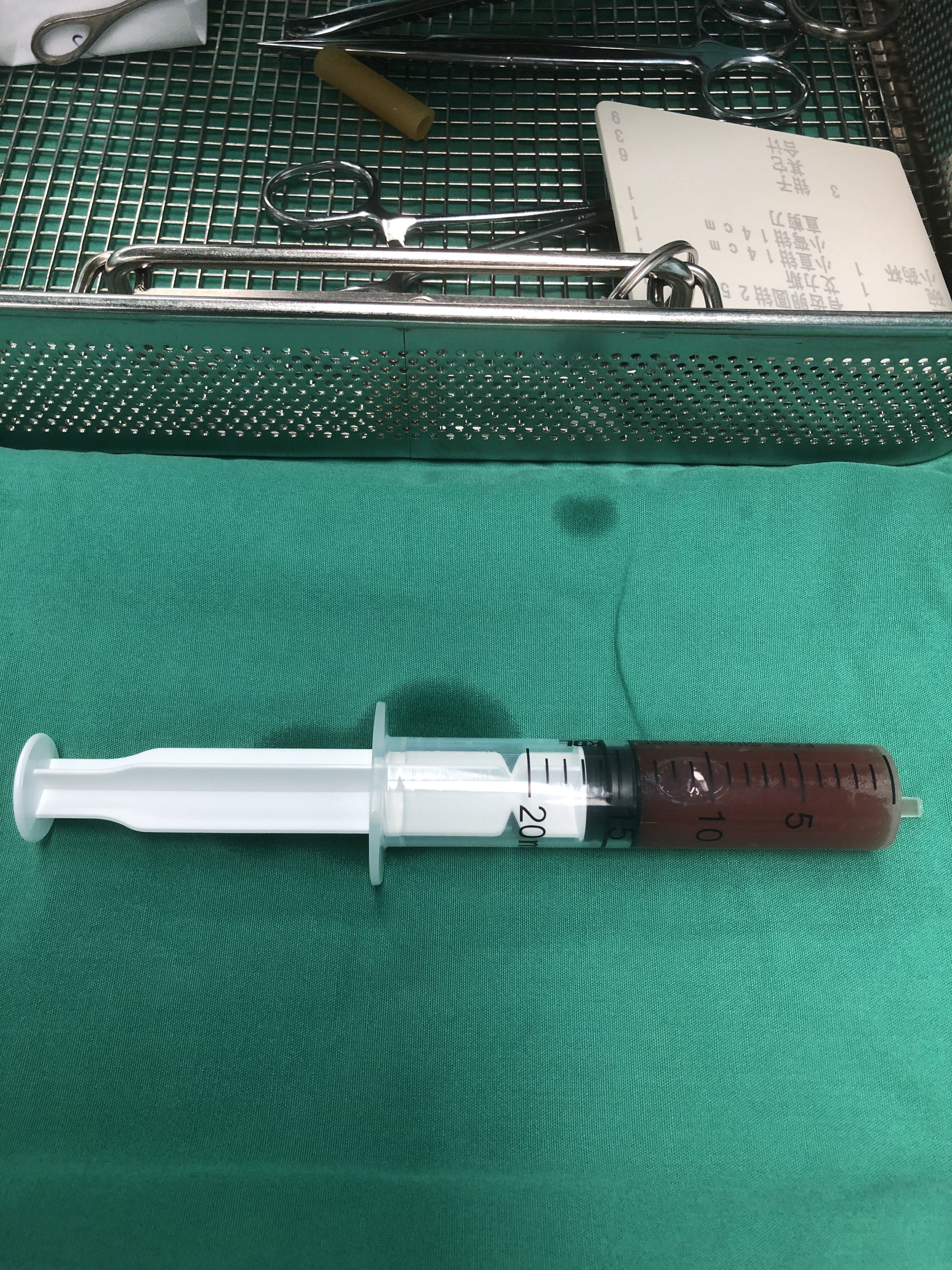 手术日志29精囊镜手术治疗血精无精精索静脉曲张显微手术