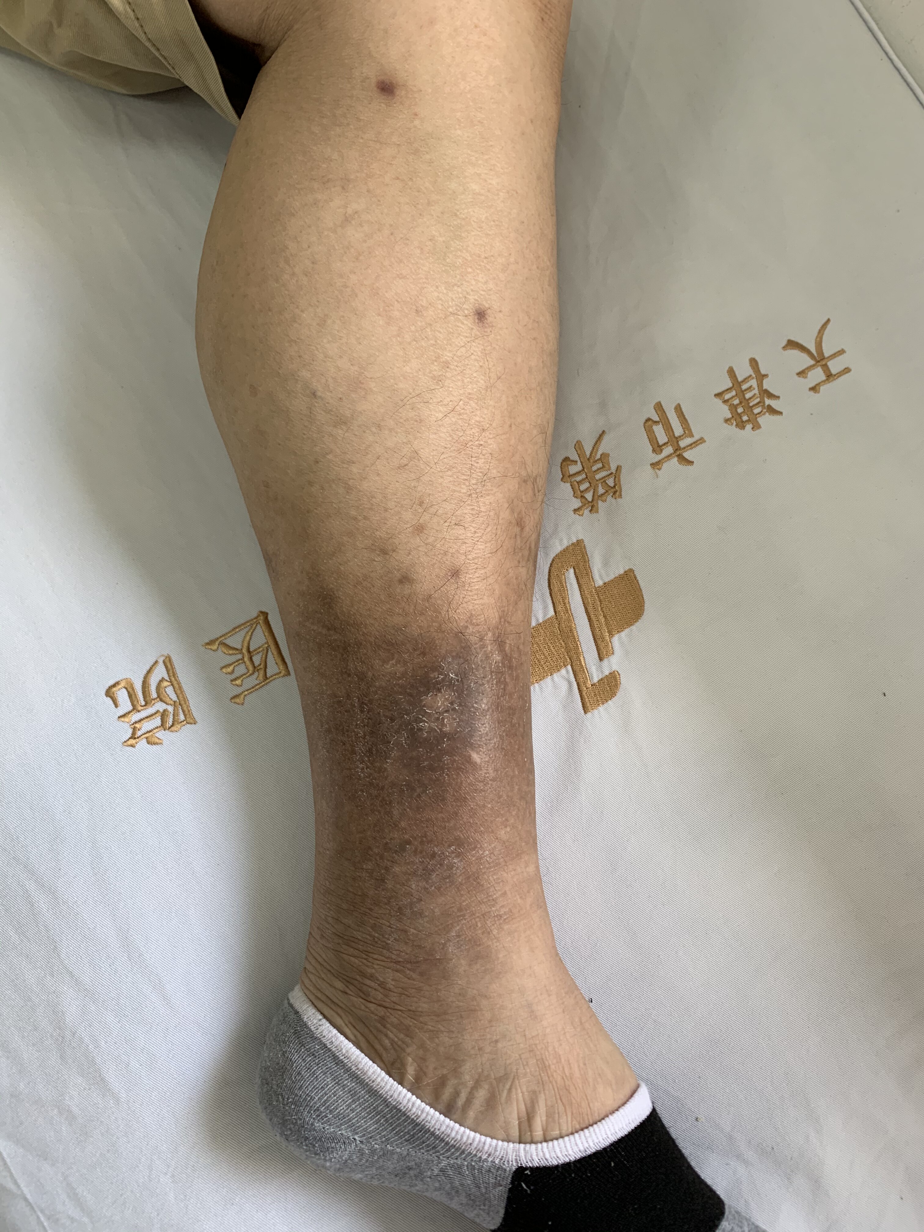 下肢静脉曲张另一种表现 色素沉着破溃 单纯性下肢静脉曲张 单纯性下肢静脉曲张 下肢静脉曲张另一种表现 色素沉着破溃 单纯性下肢静脉曲张 单纯性下肢静脉曲张