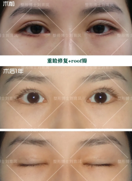 双眼皮修复十问十答 双眼皮修复