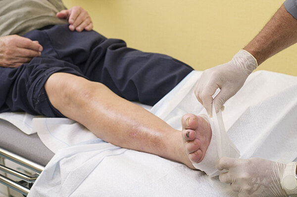 糖尿病足的症状及表现,不同分级治疗方法_糖尿病足_介绍_症状表现