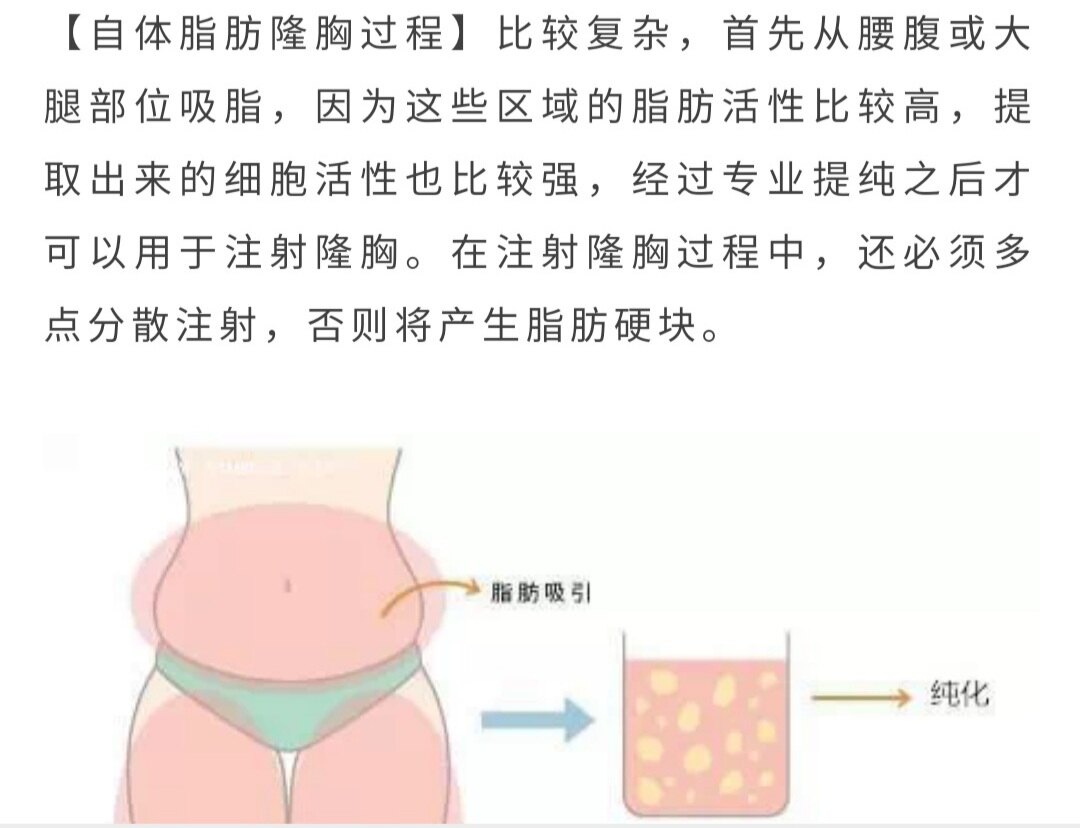 假体隆胸和自体脂肪移植隆胸的优缺点 隆胸 假体隆胸和自体脂肪移植隆胸的优缺点 隆胸