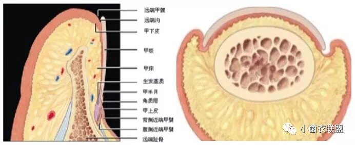 得了甲溝炎我該怎麼辦一定要拔甲嗎