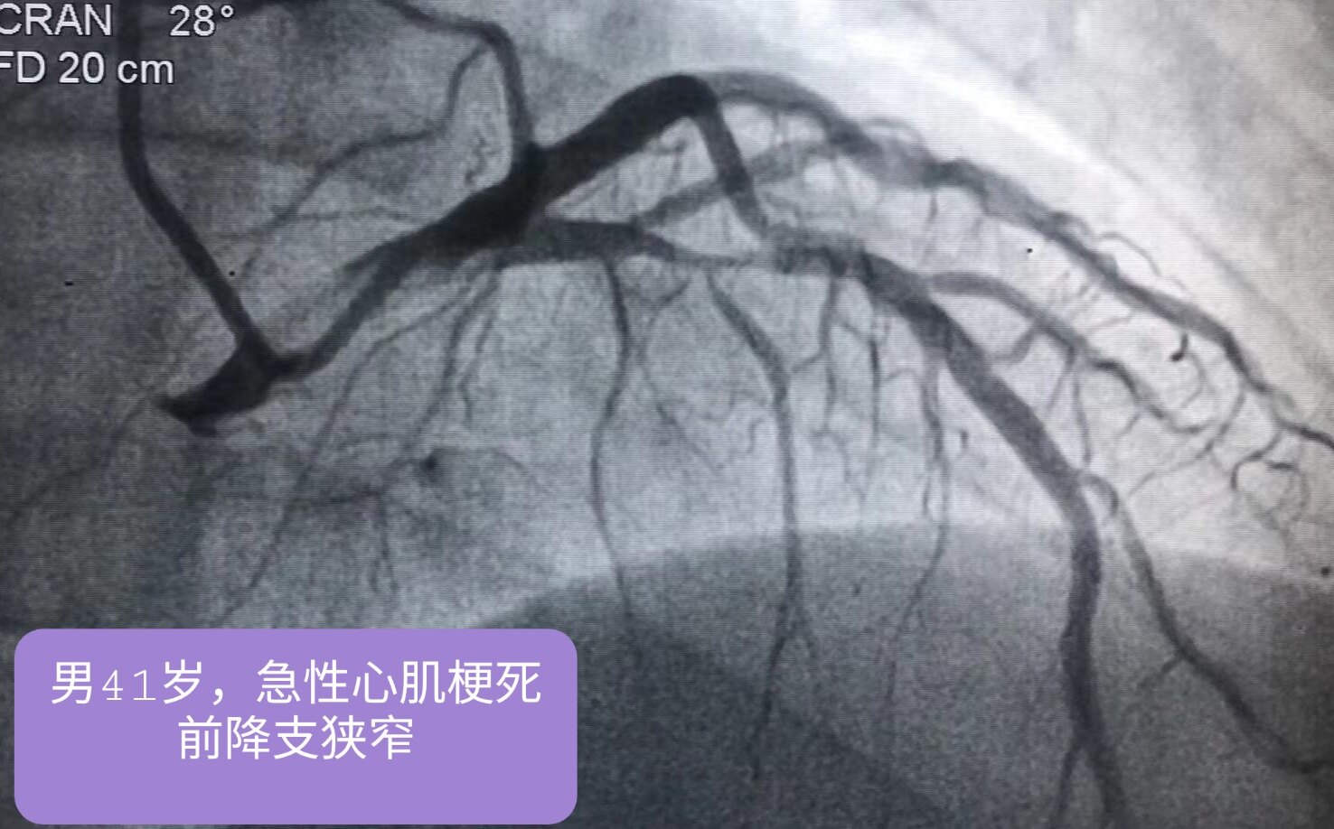 冠状动脉粥样硬化狭窄程度图解