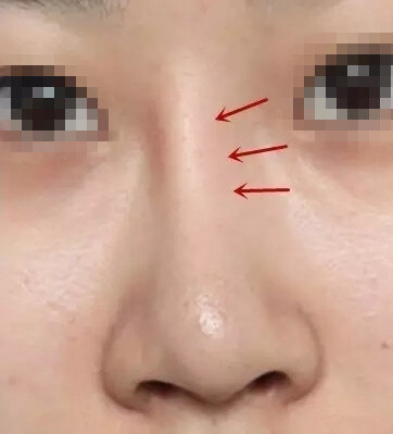 做鼻修复 为什么医生总是说还不行 再等等 鼻部整形 鼻部整形 做鼻修复 为什么医生总是说还不行 再等等 鼻部整形 鼻部整形