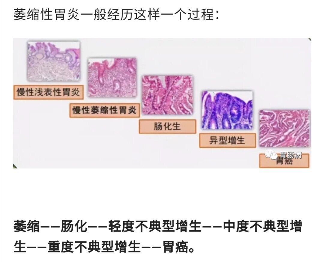 慢性萎縮性胃炎可癌變,但癌變幾率不高,多數研究發現癌變率不超過3%