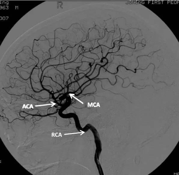 大脑动脉解剖图影像学图片