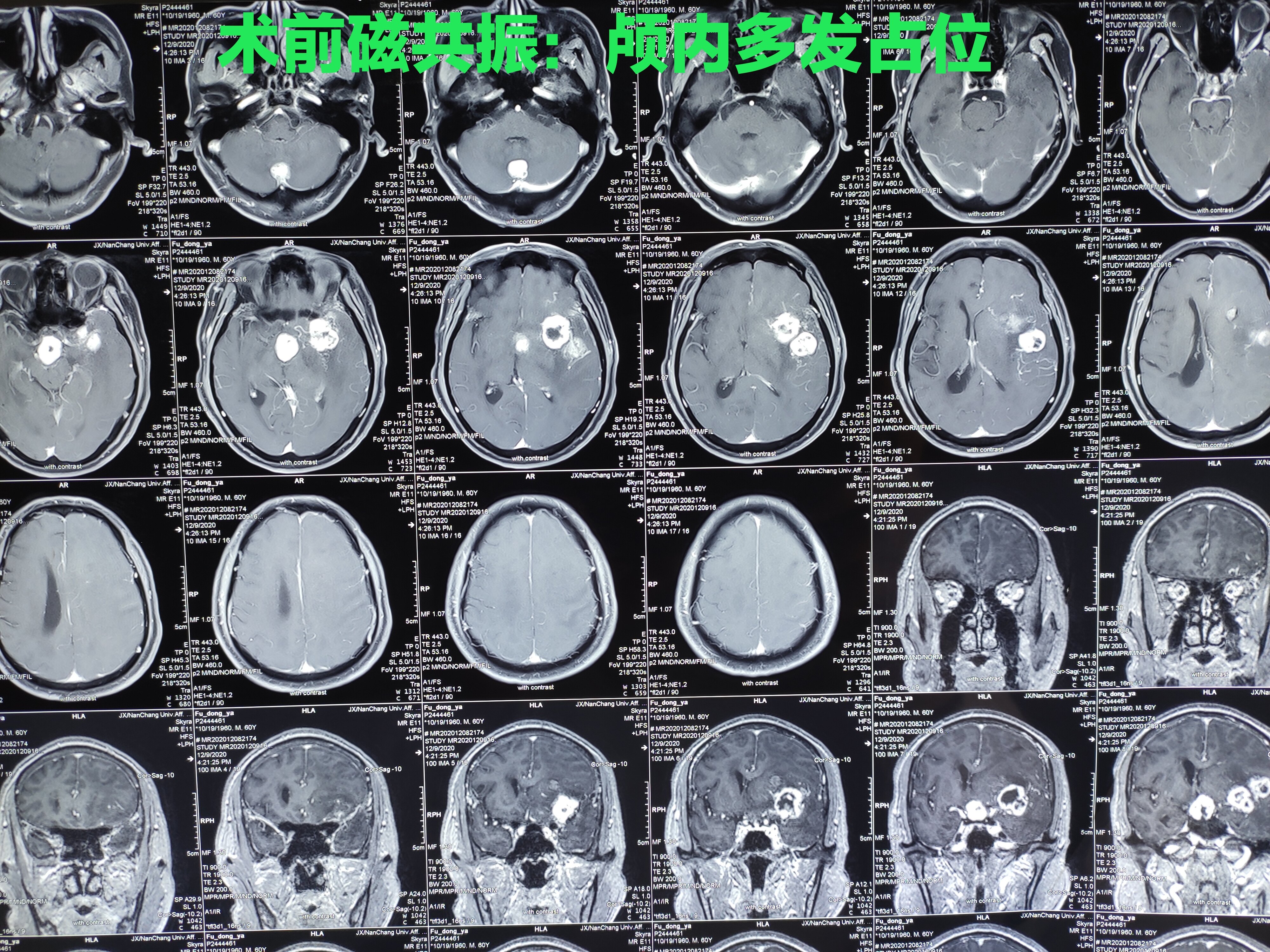 术前脑恶性肿瘤术后病理良性肿瘤 - 好大夫在线